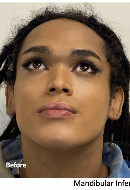 Facial Feminization Before & After Patient #2220