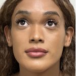 Facial Feminization Before & After Patient #2220