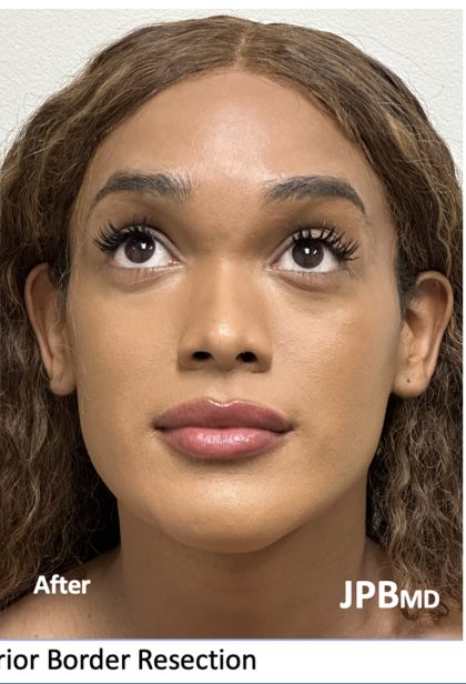 Facial Feminization Before & After Patient #2220