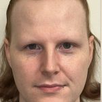 Facial Feminization Before & After Patient #2195