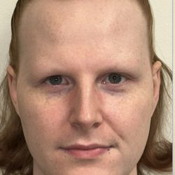 Facial Feminization Before & After Patient #2195