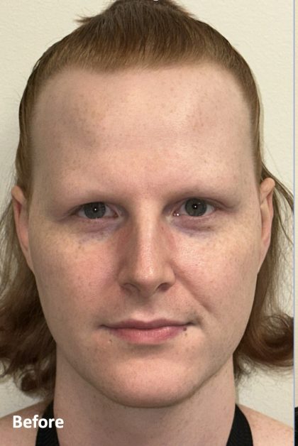 Facial Feminization Before & After Patient #2195