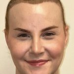 Facial Feminization Before & After Patient #2195