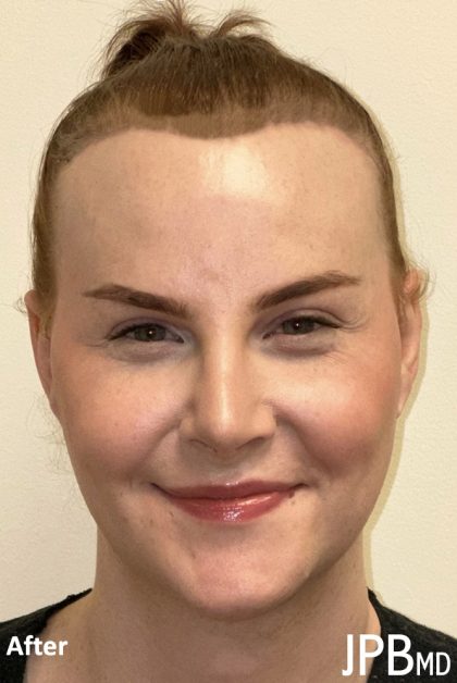 Facial Feminization Before & After Patient #2195