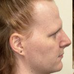 Facial Feminization Before & After Patient #2195