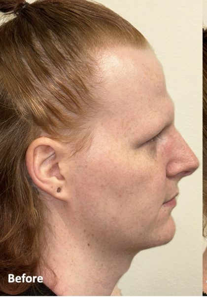 Facial Feminization Before & After Patient #2195