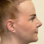 Facial Feminization Before & After Patient #2195