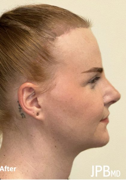 Facial Feminization Before & After Patient #2195