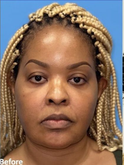 Facial Feminization Before & After Patient #2217