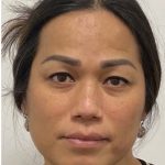 Facial Feminization Before & After Patient #2218
