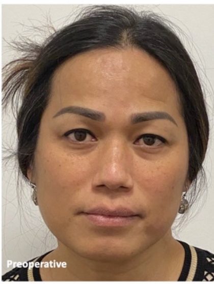 Facial Feminization Before & After Patient #2218