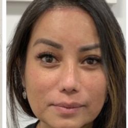 Facial Feminization Before & After Patient #2218