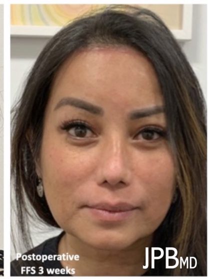 Facial Feminization Before & After Patient #2218