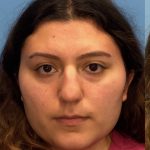 Rhinoplasty Before & After Patient #2178