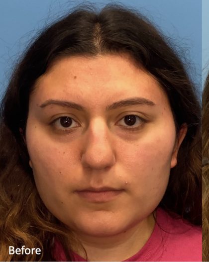 Rhinoplasty Before & After Patient #2178