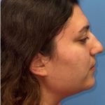 Rhinoplasty Before & After Patient #2178