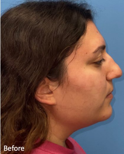 Rhinoplasty Before & After Patient #2178