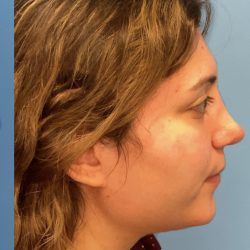 Rhinoplasty Before & After Patient #2178