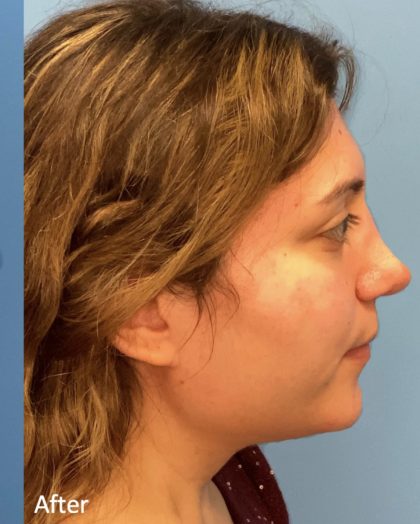 Rhinoplasty Before & After Patient #2178
