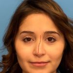 Rhinoplasty Before & After Patient #2182