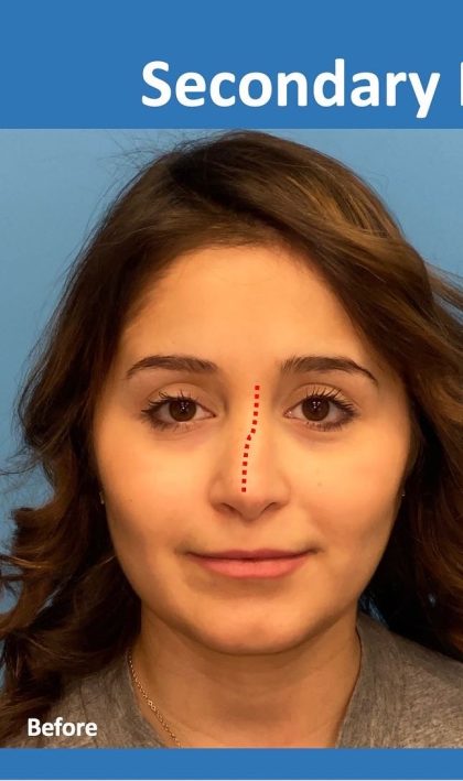 Rhinoplasty Before & After Patient #2182