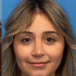 Rhinoplasty Before & After Patient #2182