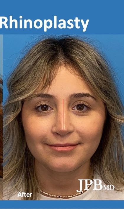 Rhinoplasty Before & After Patient #2182