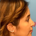 Rhinoplasty Before & After Patient #2182