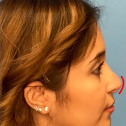 Rhinoplasty Before & After Patient #2182
