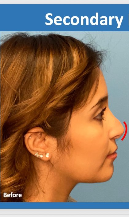 Rhinoplasty Before & After Patient #2182