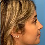 Rhinoplasty Before & After Patient #2182