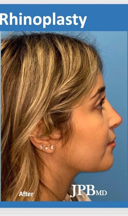 Rhinoplasty Before & After Patient #2182
