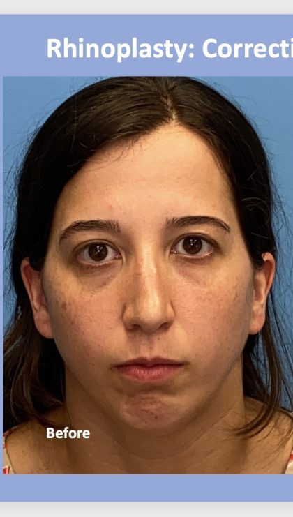 Rhinoplasty Before & After Patient #2183