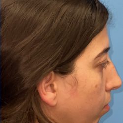 Rhinoplasty Before & After Patient #2183