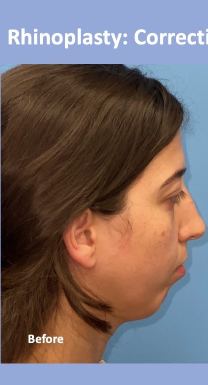 Rhinoplasty Before & After Patient #2183