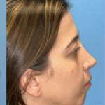 Rhinoplasty Before & After Patient #2183