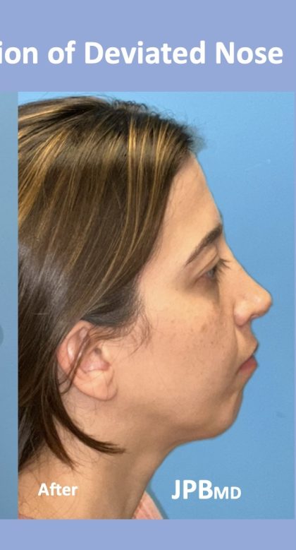 Rhinoplasty Before & After Patient #2183