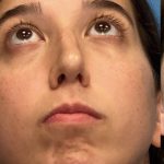 Rhinoplasty Before & After Patient #2183