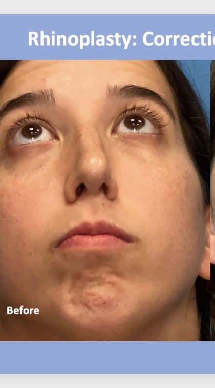 Rhinoplasty Before & After Patient #2183