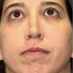 Rhinoplasty Before & After Patient #2183