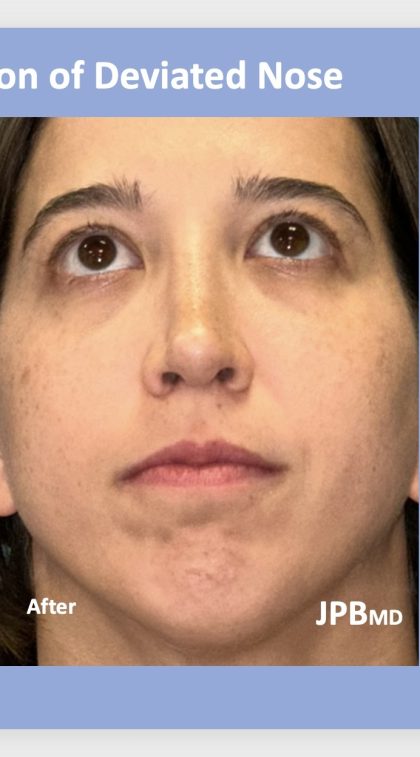 Rhinoplasty Before & After Patient #2183