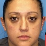 Rhinoplasty Before & After Patient #2184
