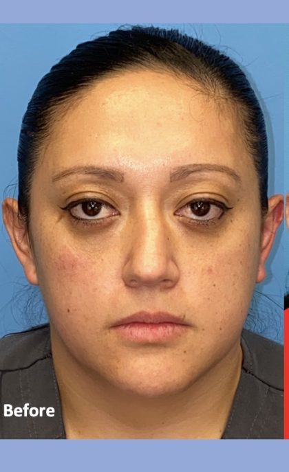 Rhinoplasty Before & After Patient #2184