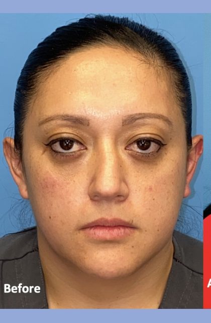 Rhinoplasty Before & After Patient #2184