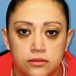 Rhinoplasty Before & After Patient #2184