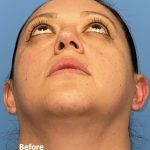Rhinoplasty Before & After Patient #2184