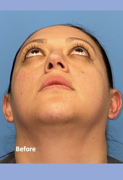 Rhinoplasty Before & After Patient #2184