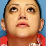 Rhinoplasty Before & After Patient #2184