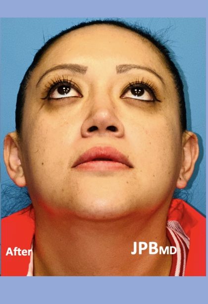 Rhinoplasty Before & After Patient #2184