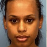 Rhinoplasty Before & After Patient #2185